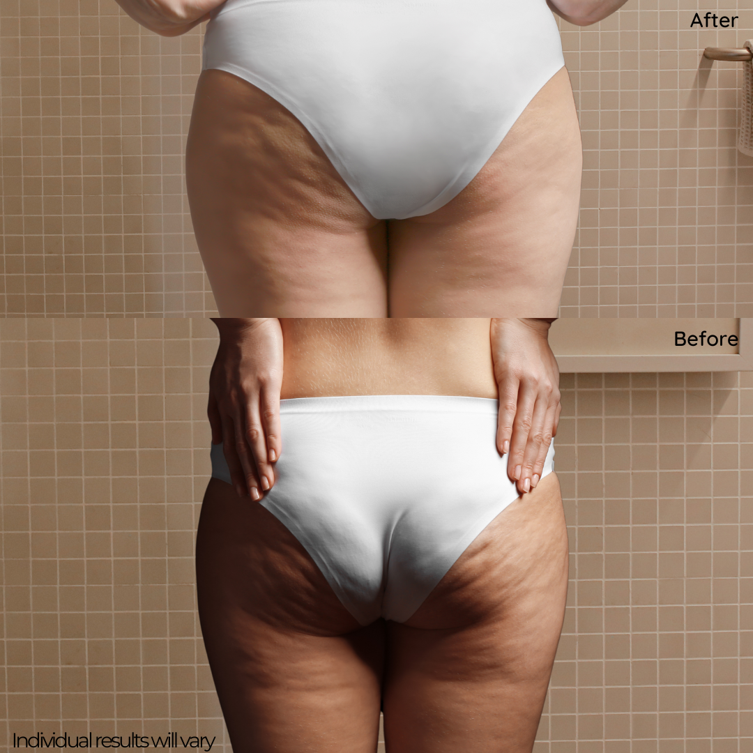 Cellulite Stimulation Kit