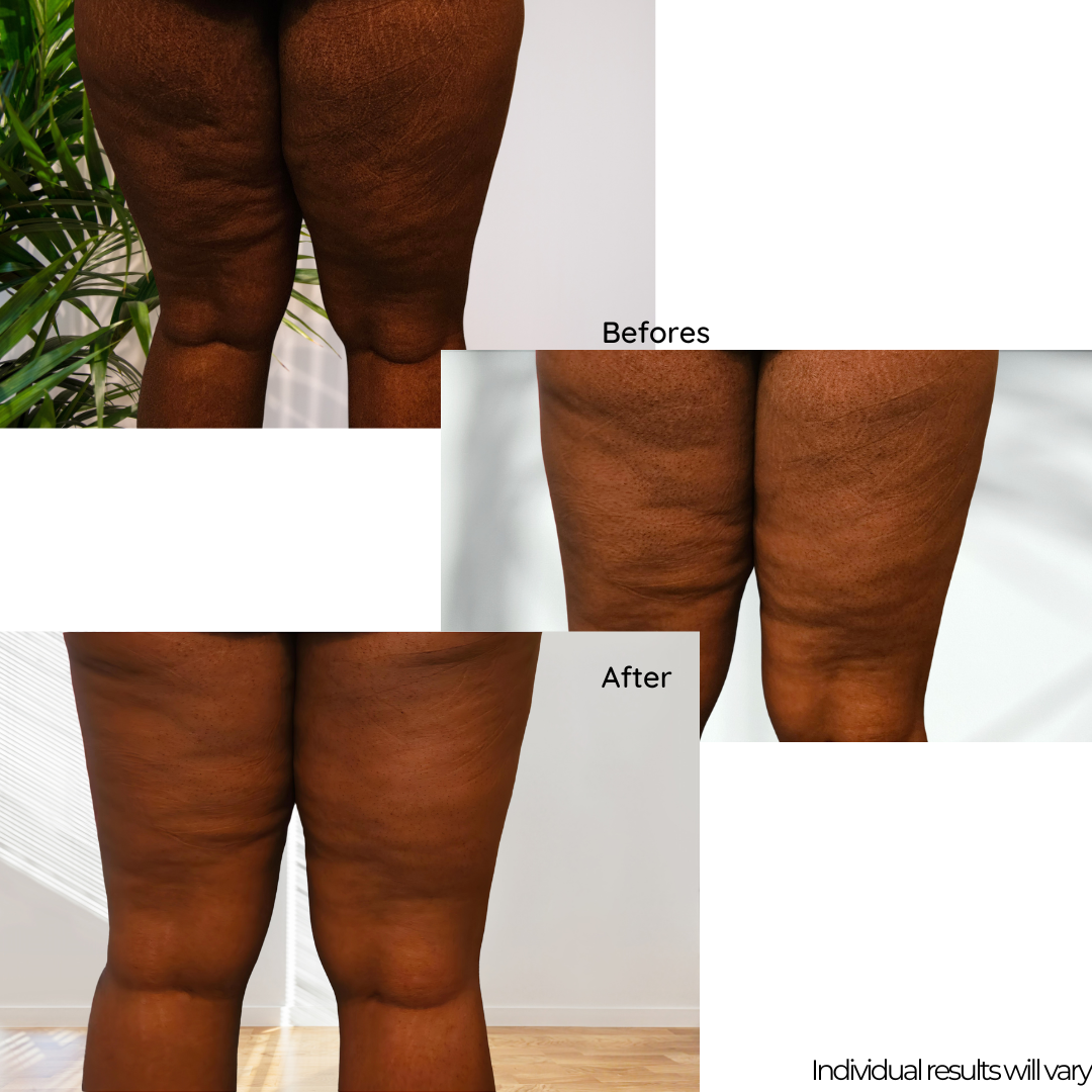 Cellulite Stimulation Kit