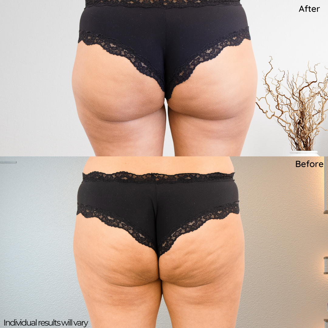 Cellulite Stimulation Kit